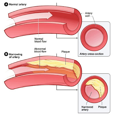 coronary artery disease